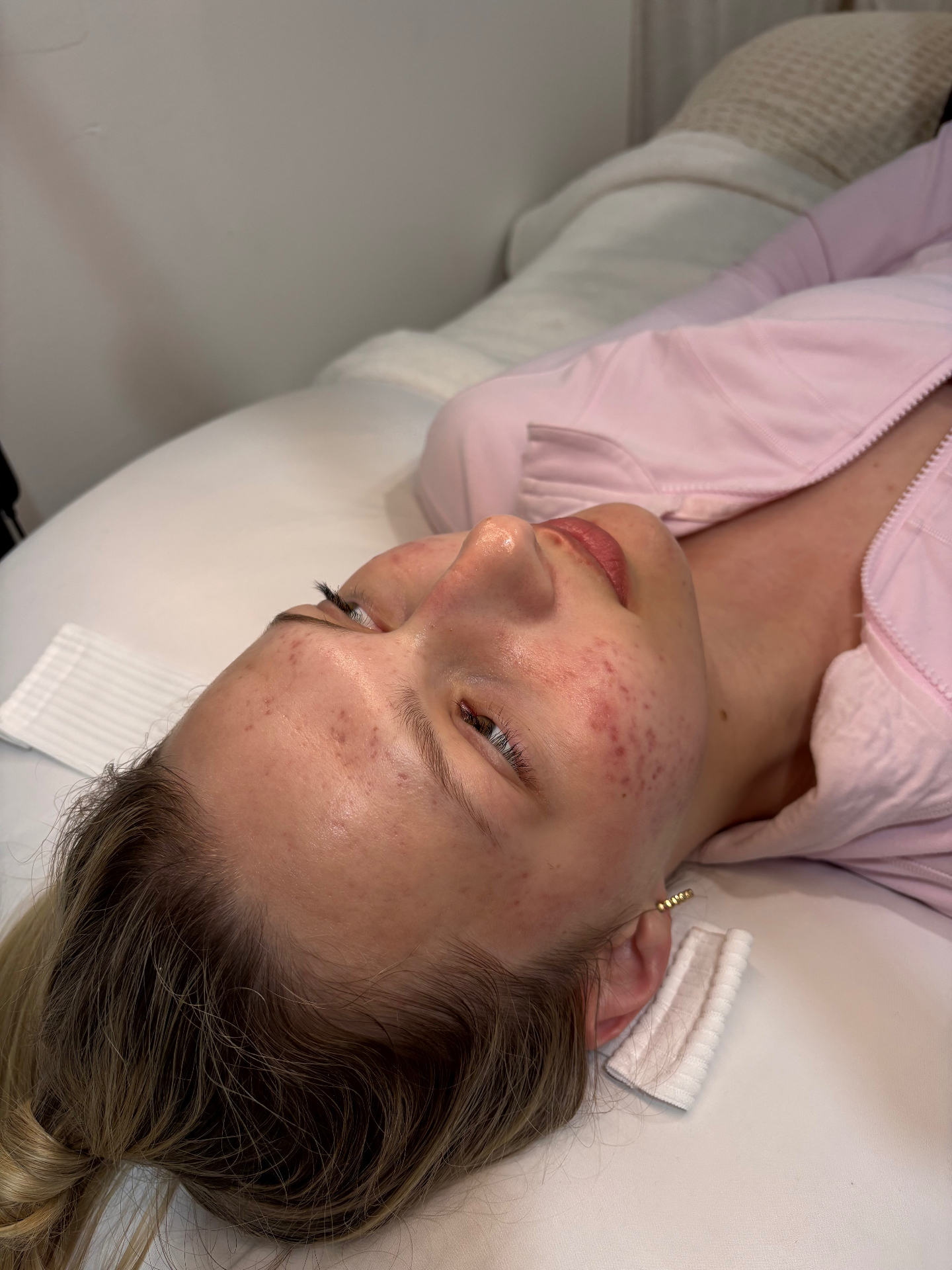Same client with significantly clearer, calmer skin after Face Reality acne program