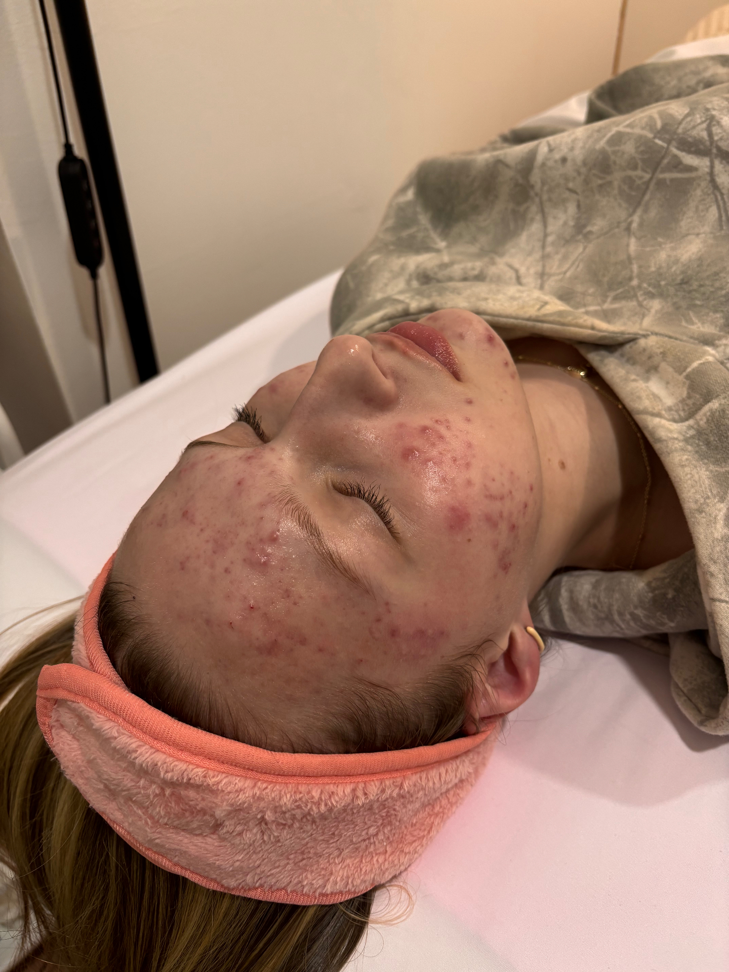 Client with active acne breakouts before treatment at Angel Skin